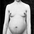309px-23jahrigeSchwangere kurz vor derGeburt